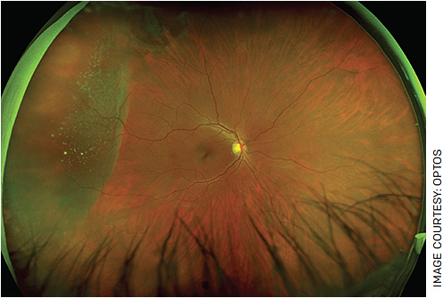 FIGURE 2. Color fundus photo of an eye with retinal detachment