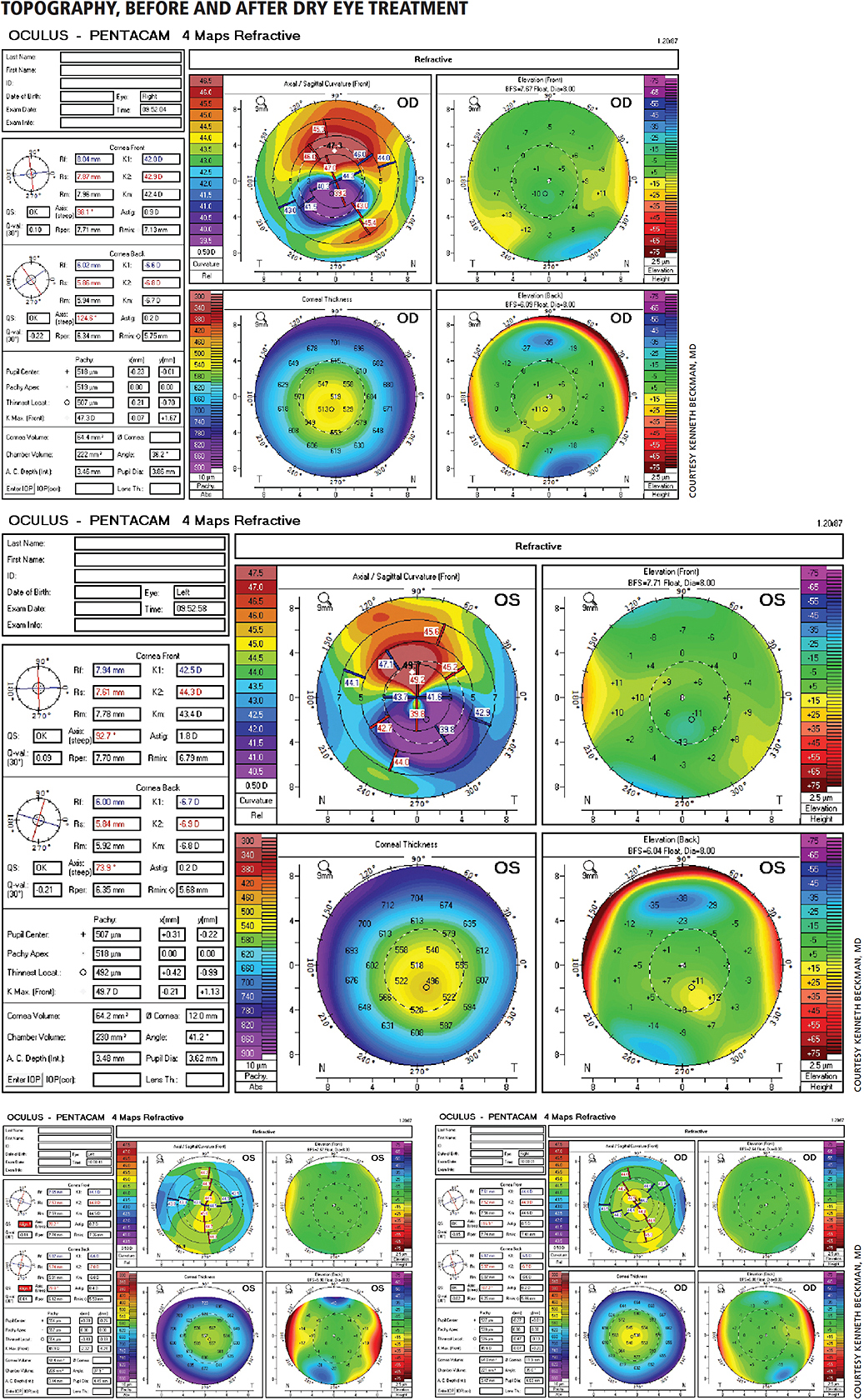 Reclaiming Vision In Dry-Eye Syndrome