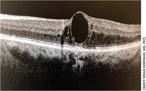 Figure 1. A case of DME in an 86-year-old female with type 2 diabetes. OCT shows edema of the fovea with chronic cyst.
