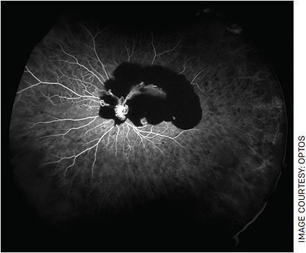 FIGURE 1. FA of an eye with advanced diabetic retinopathy
