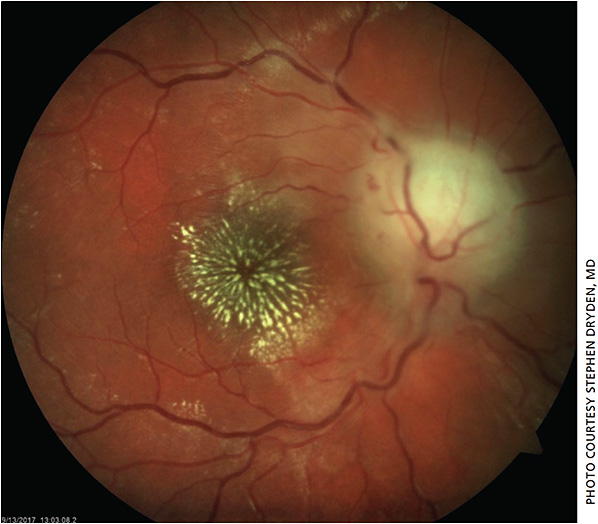 right-optic-nerve-showing-chalky-pallor-with-swollen-disc-arrow